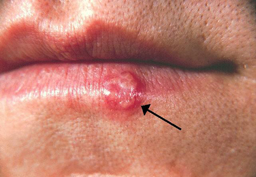 Image of Cold Sore